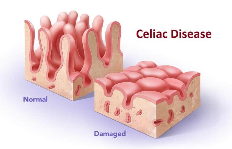 Coeliac Disease Medsana Medical Clinic