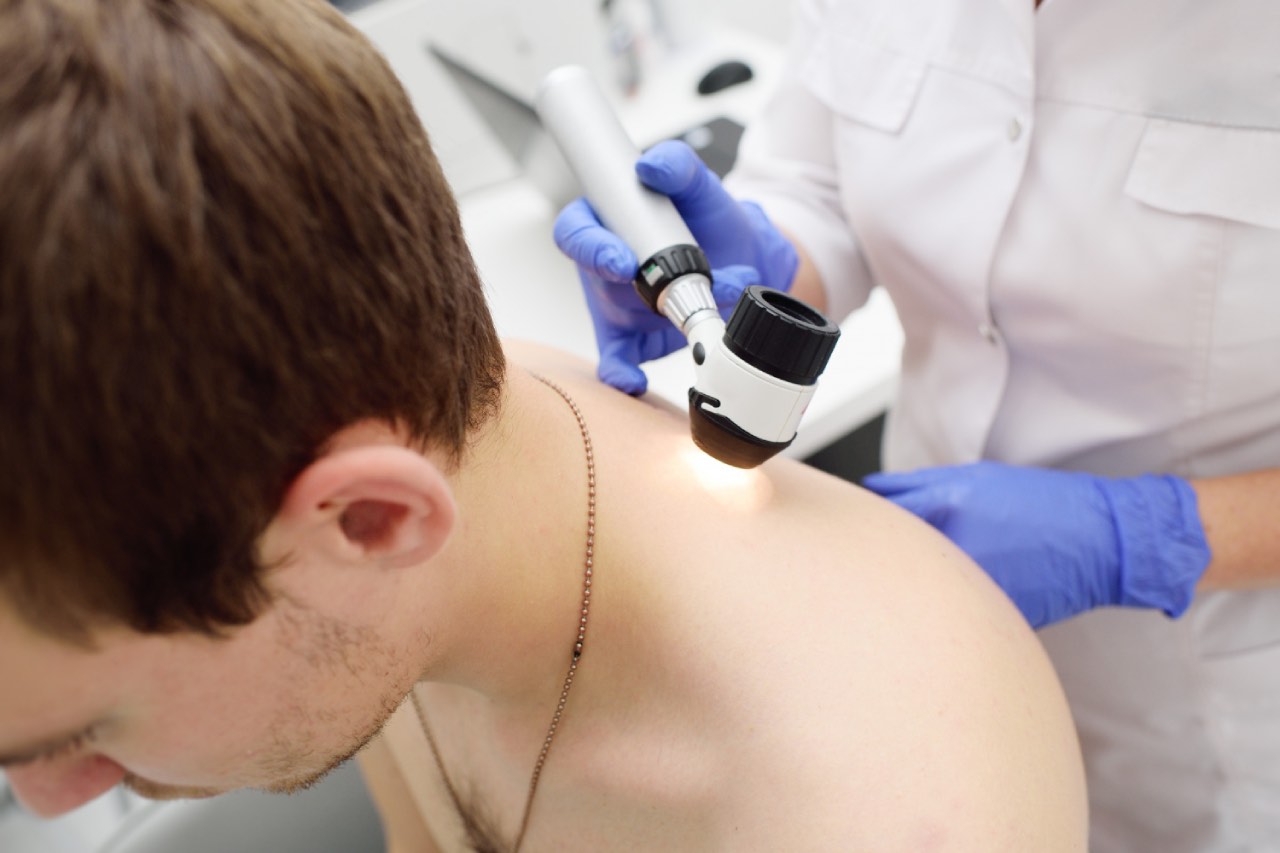 Young man receiving skin cancer check on his mole on the back by the doctor using dermatoscope.
