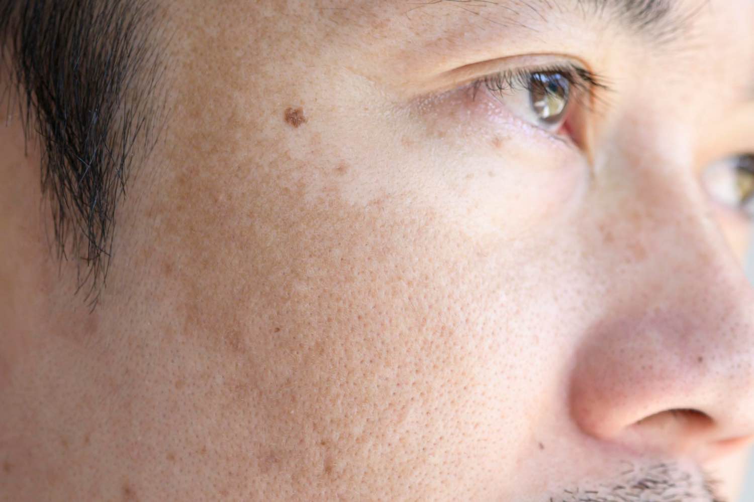 Asian man with freckles and mole on face