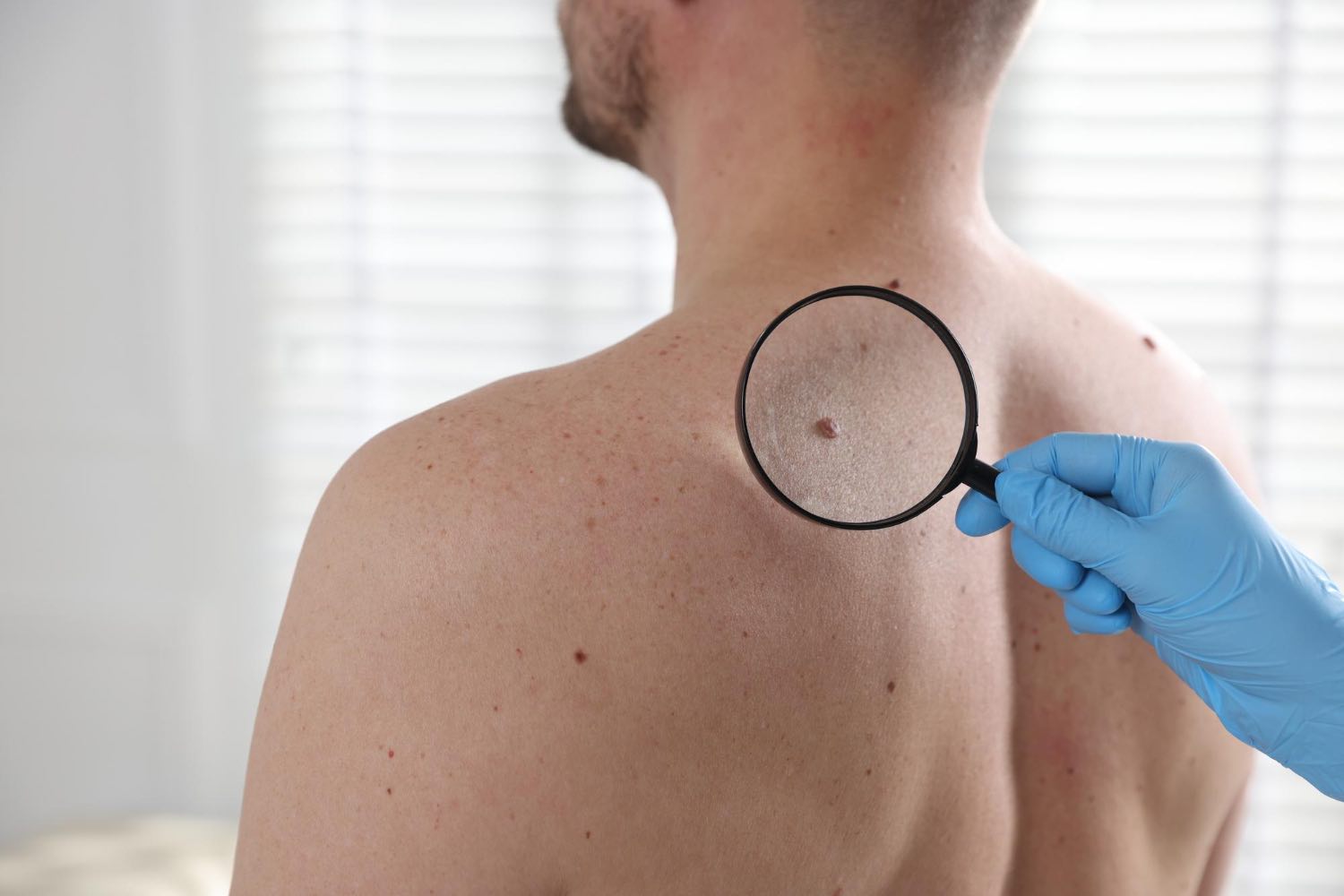 Middle aged man having skin cancer check on his mole by doctor
